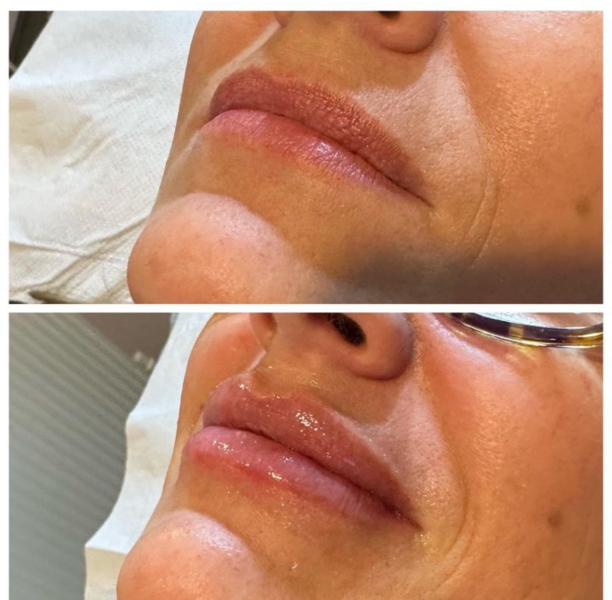 Lip fillers- are the agony?