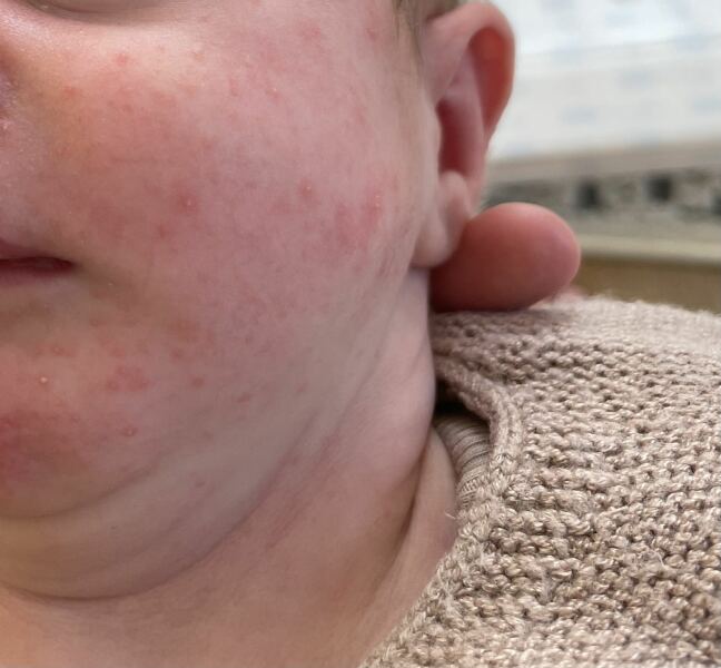 5 week old - diarrhoea frothy poo? Photo warning