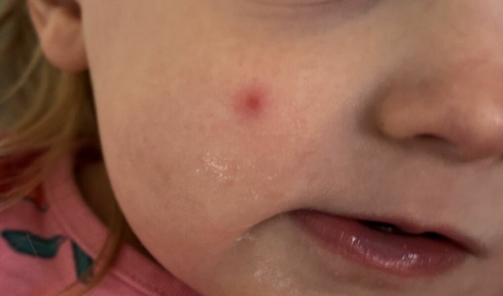 Red spot on child’s cheek that won’t go away