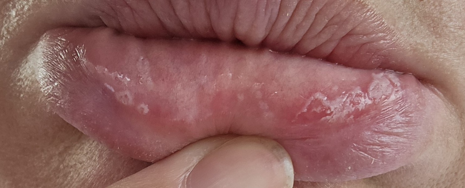 What is this inside my mouth?