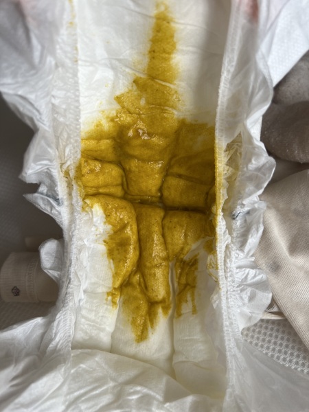 Diarrhea or normal - 5 month old baby