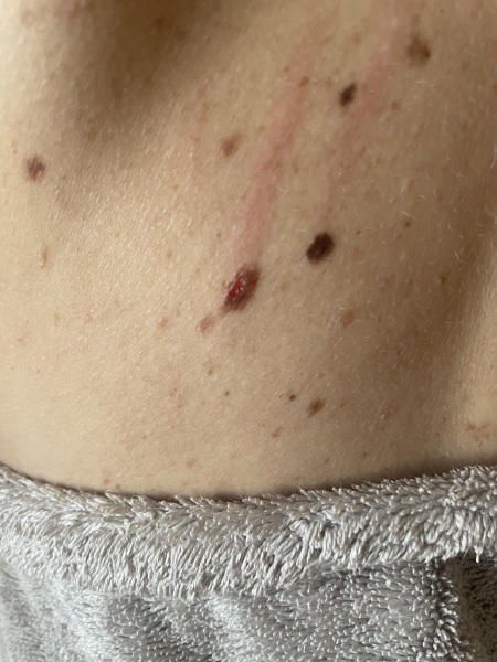 Worried about mole
