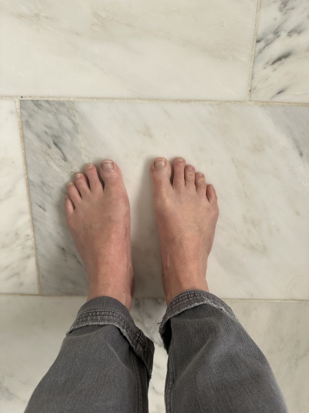 Bunion Keyhole surgery