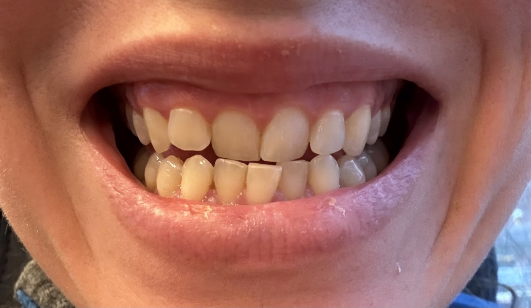 Adult teeth straightening - share your wisdom/experience! 🙏🏻