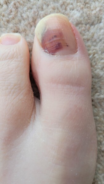 Toe issue with slightly unpleasant photo