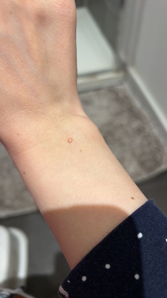 Mole Concerning?