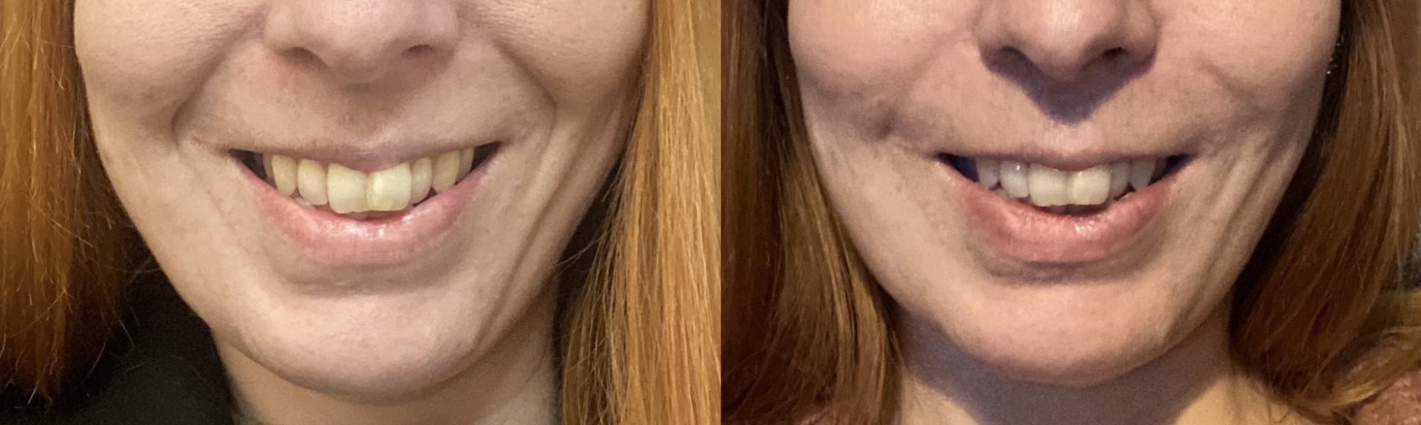 Fillers?