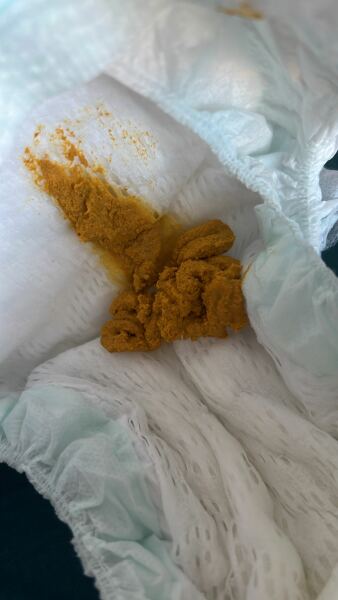 Breastfed baby - is this poo normal?