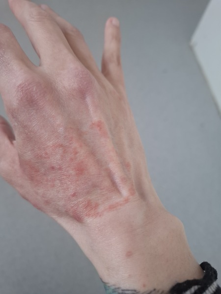 Hand infected (Warning, gross photos)