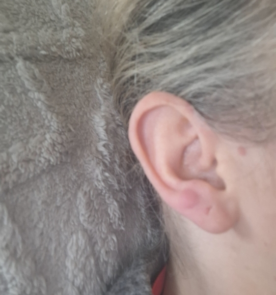 **pic attached** what is this lump behind my ear??