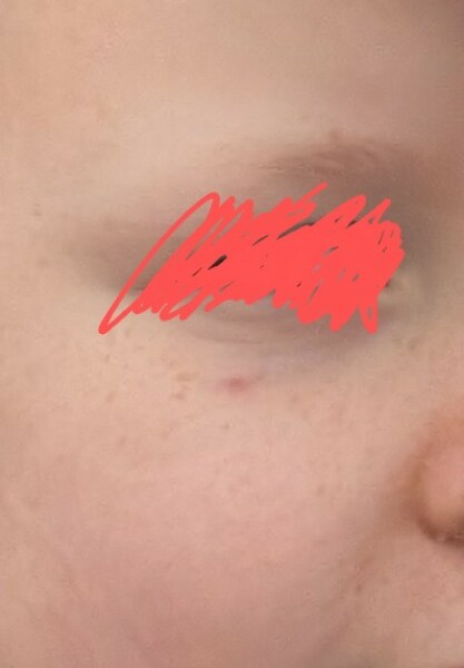 'spot' under child's eye - won't go