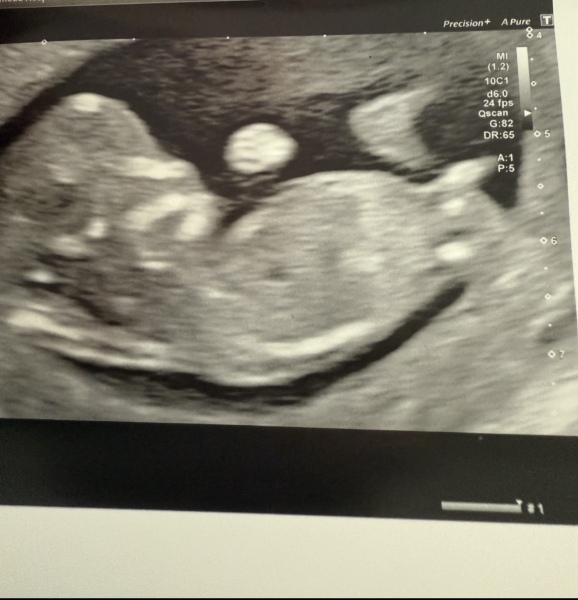 Can you see a nub? Boy or girl?