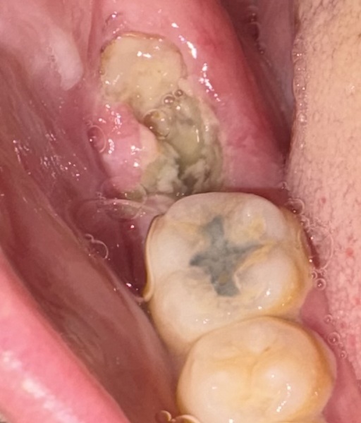 Is this dry socket?