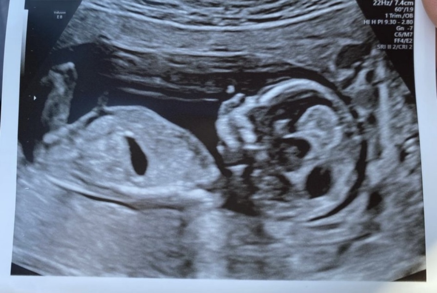 Boy or girl (nub theory)