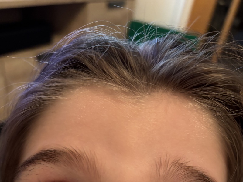 Lump on forehead when raising eyebrows
