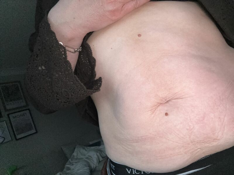 Has anyone found something to help loose skin on the stomach that doesn’t involve surgical procedure?