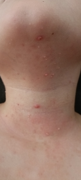 Chicken pox or Molluscum or something else 🤔