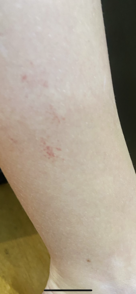 To present to ED with 13yr old rash.