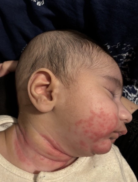 BABY NECK AND FACE RASH PLZ HELP!!