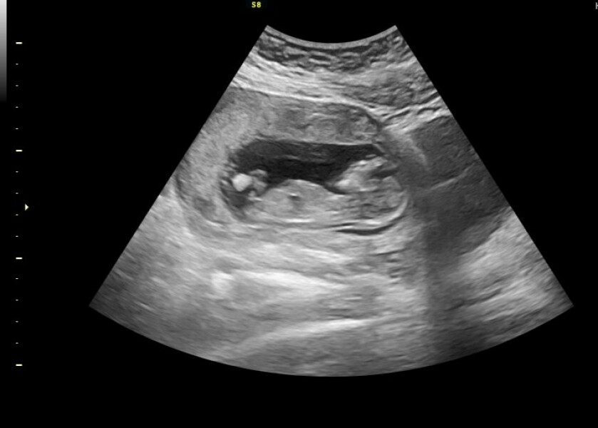 14 weeks boy or girl?