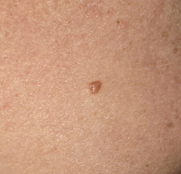 Does this mole look okay?