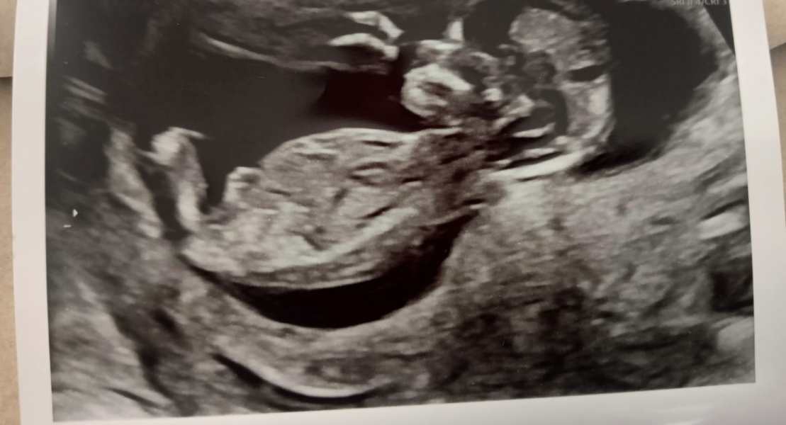 12 week scan picture