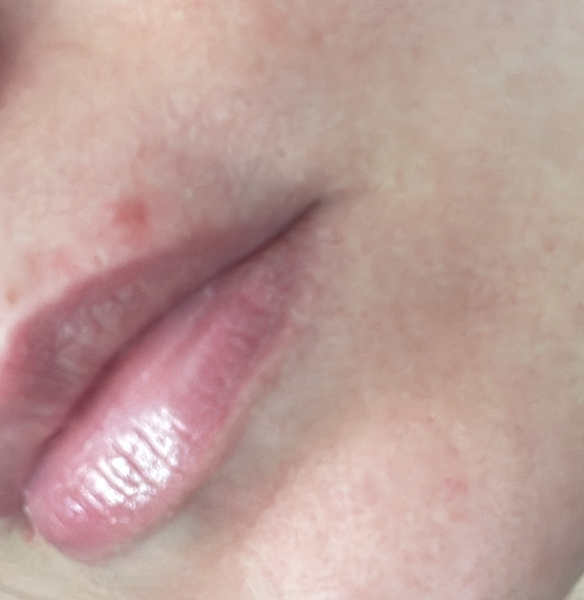 Is this a coldsore?