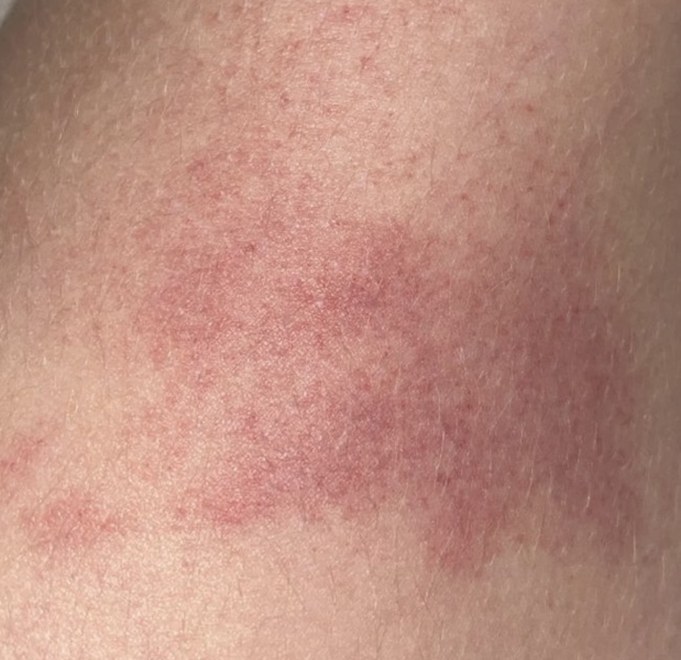 To present to ED with 13yr old rash.