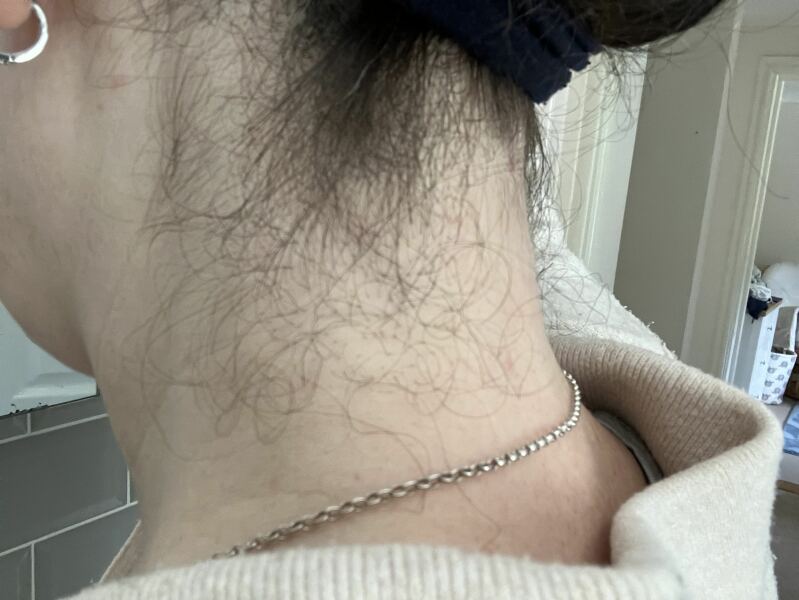 Has anyone had the hairline on their neck lasered?