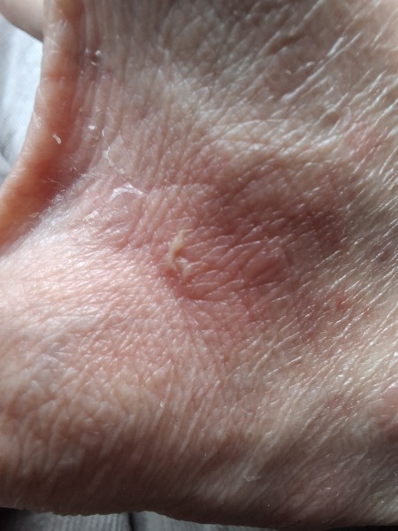 Hand infected (Warning, gross photos)