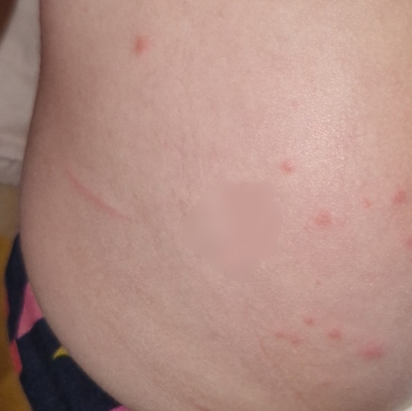 Could this be chicken pox?
