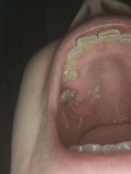 Dry Socket?