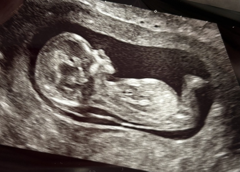 3.8mm NT at 13 weeks