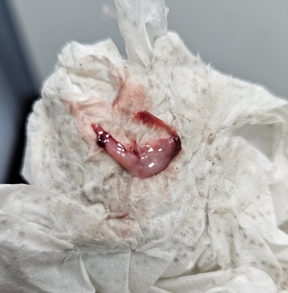 Is this a miscarriage? Warning: graphic photo