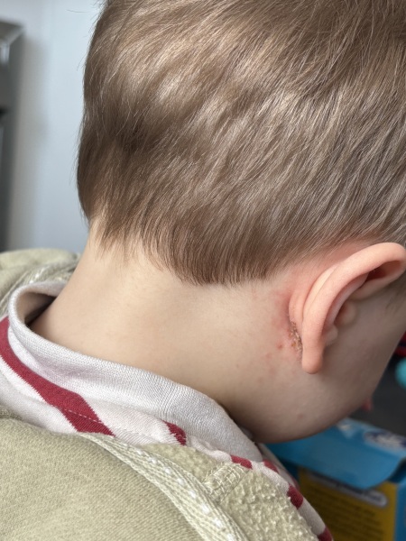 Scabby/ weeping behind ear