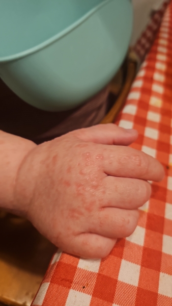 Does anybody recognise this rash?