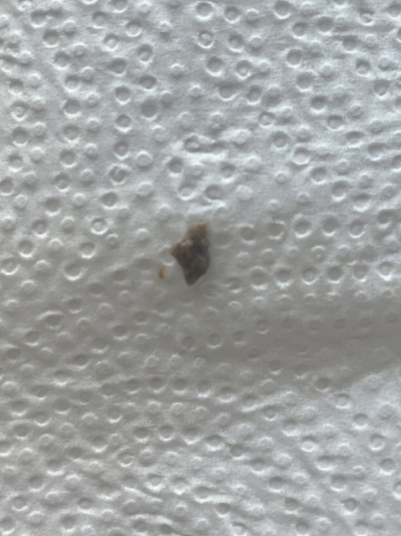 This rotting, foul smelling mush just fell out of my tooth extraction site