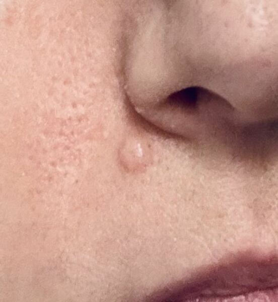 Basal cell carcinoma - help?