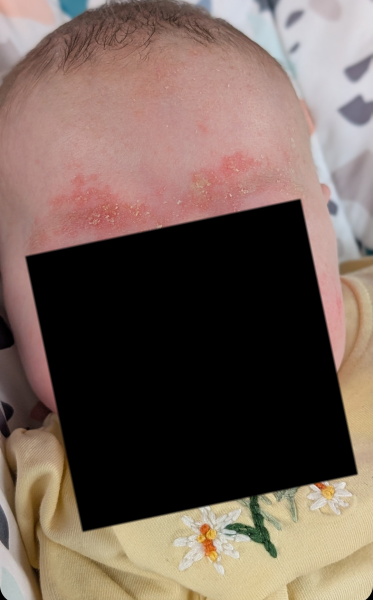 Anyone know what this is on my babys face ?