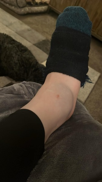 Hurt my ankle on holiday wwyd