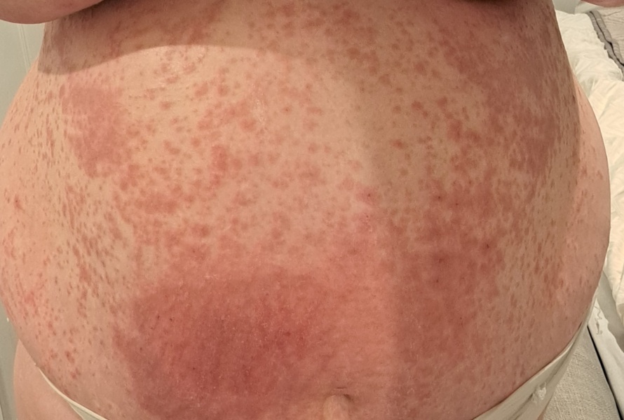Pupps or scabies?!! Help!