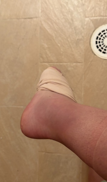 Hurt my ankle on holiday wwyd