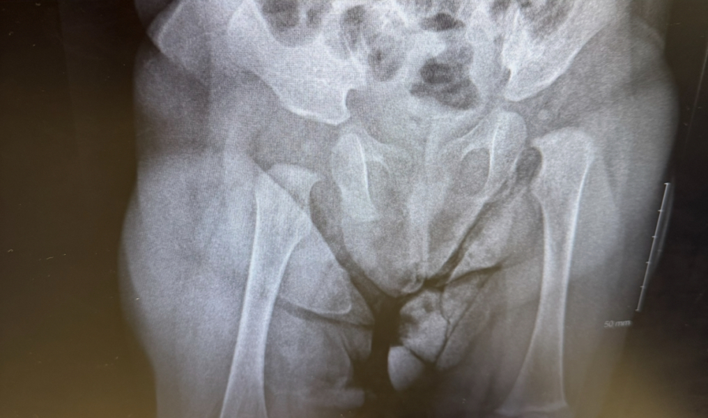 Legs length difference. Obliquity of the pelvis