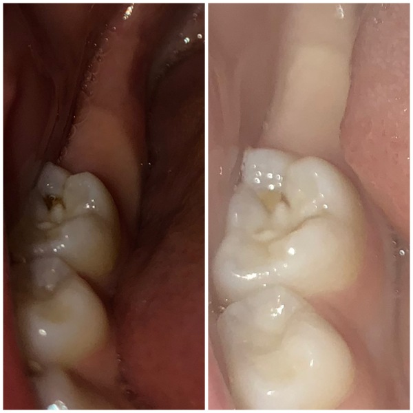 Toddler molar problem potentially