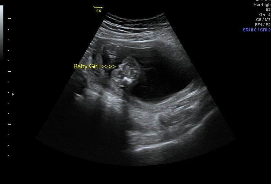 Gender scan