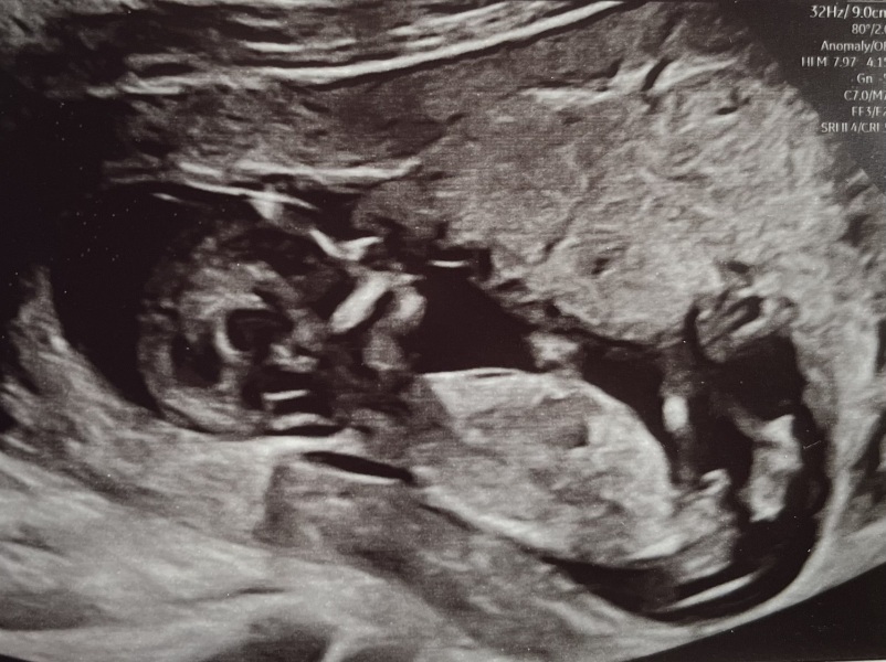 Boy or girl