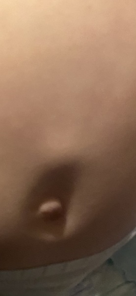 Does this look like a hernia?