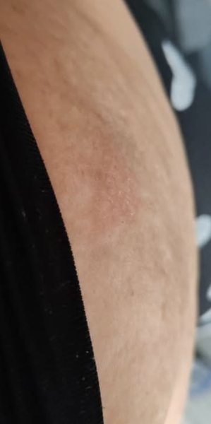 Red mark on jab site
