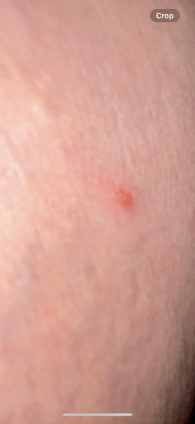 Chicken pox 3 times?!