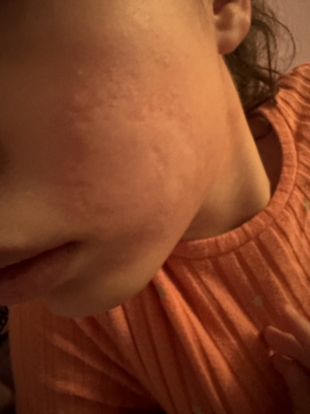 Worried - unknown allergy ? 😟